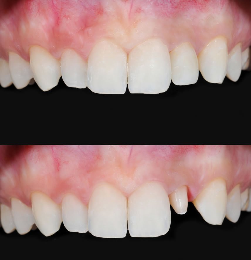 Dental Crown https://caurishealthru.com/wp-content/uploads/2024/01/Dental-Crown.jpg