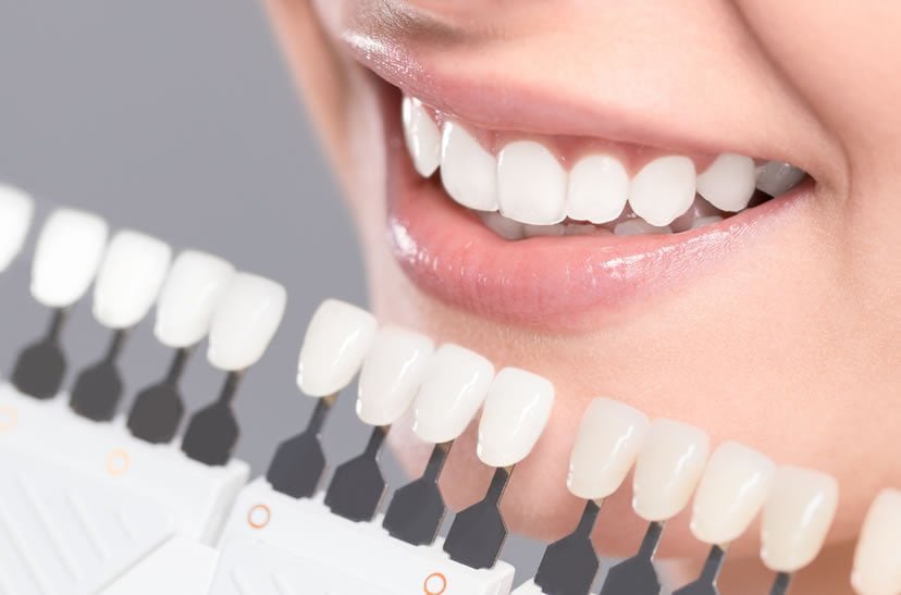 Dental Veneer https://caurishealthru.com/wp-content/uploads/2024/01/Dental-Veneer.jpg