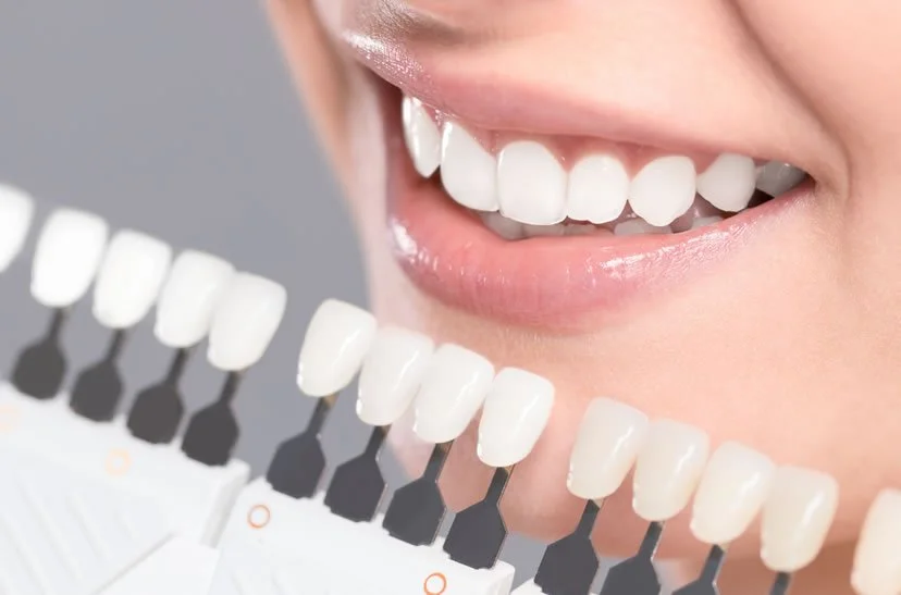 https://caurishealthru.com/wp-content/uploads/2024/01/Dental-Veneer.jpg