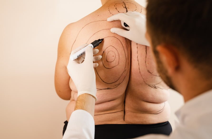 Liposuction https://caurishealthru.com/wp-content/uploads/2024/01/Liposuction.jpg