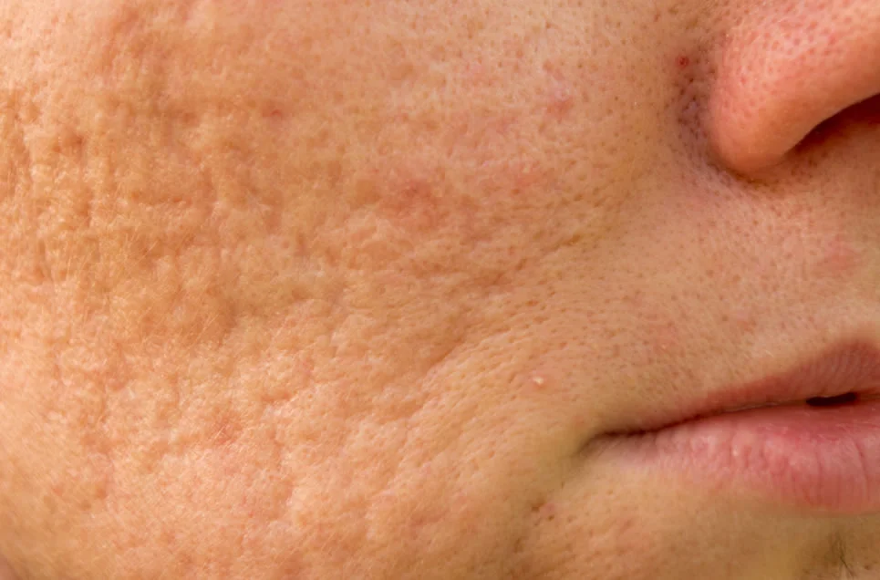 https://caurishealthru.com/wp-content/uploads/2024/01/Microneedling.jpg