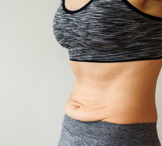 tummy-tuck https://caurishealthru.com/wp-content/uploads/2024/01/tummy-tuck.jpg