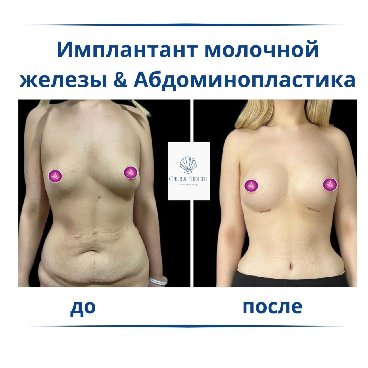 Имплантант молочной железы & Абдоминопластика